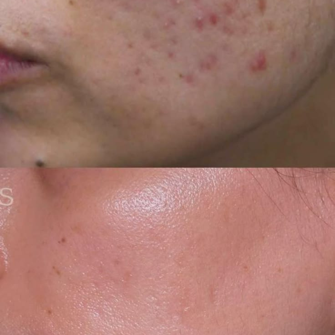DermaFuture Precision Vitamin A Serum – Revitalizing Therapy for Acne Control, Wrinkle Reduction & Collagen Boost, High Potency Formula for Clear Skin