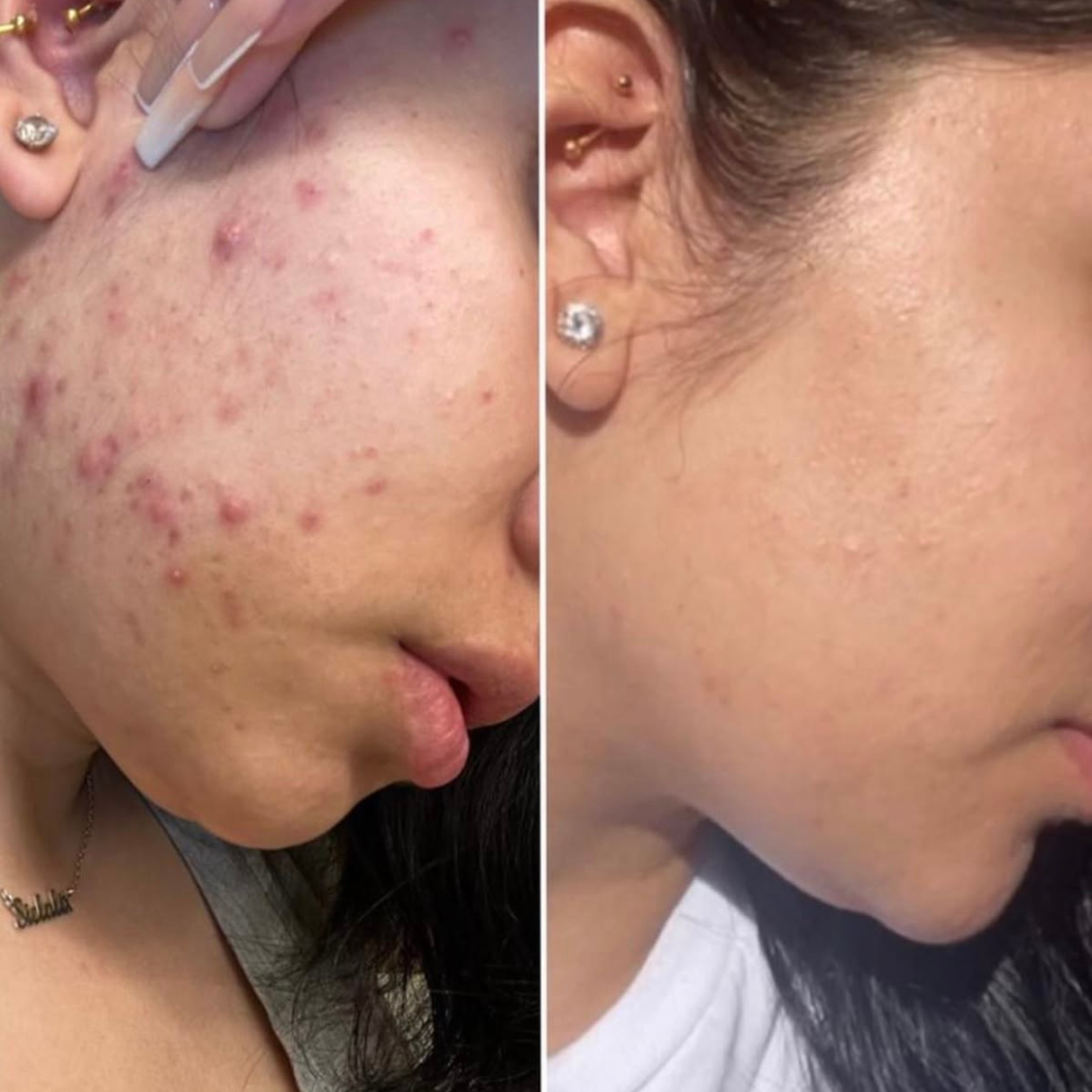 DermaFuture Precision Vitamin A Serum – Revitalizing Therapy for Acne Control, Wrinkle Reduction & Collagen Boost, High Potency Formula for Clear Skin