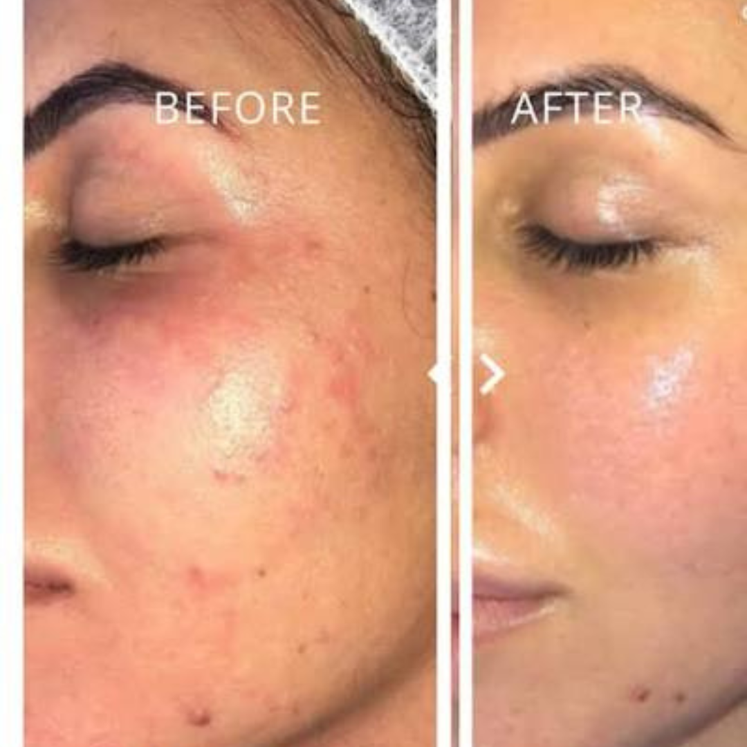 Mesoestetic Cream & Sunblock Deal - Reduce Pigmentation & Dark Spot - 50% Off - Complete care for hyperpigmentation
