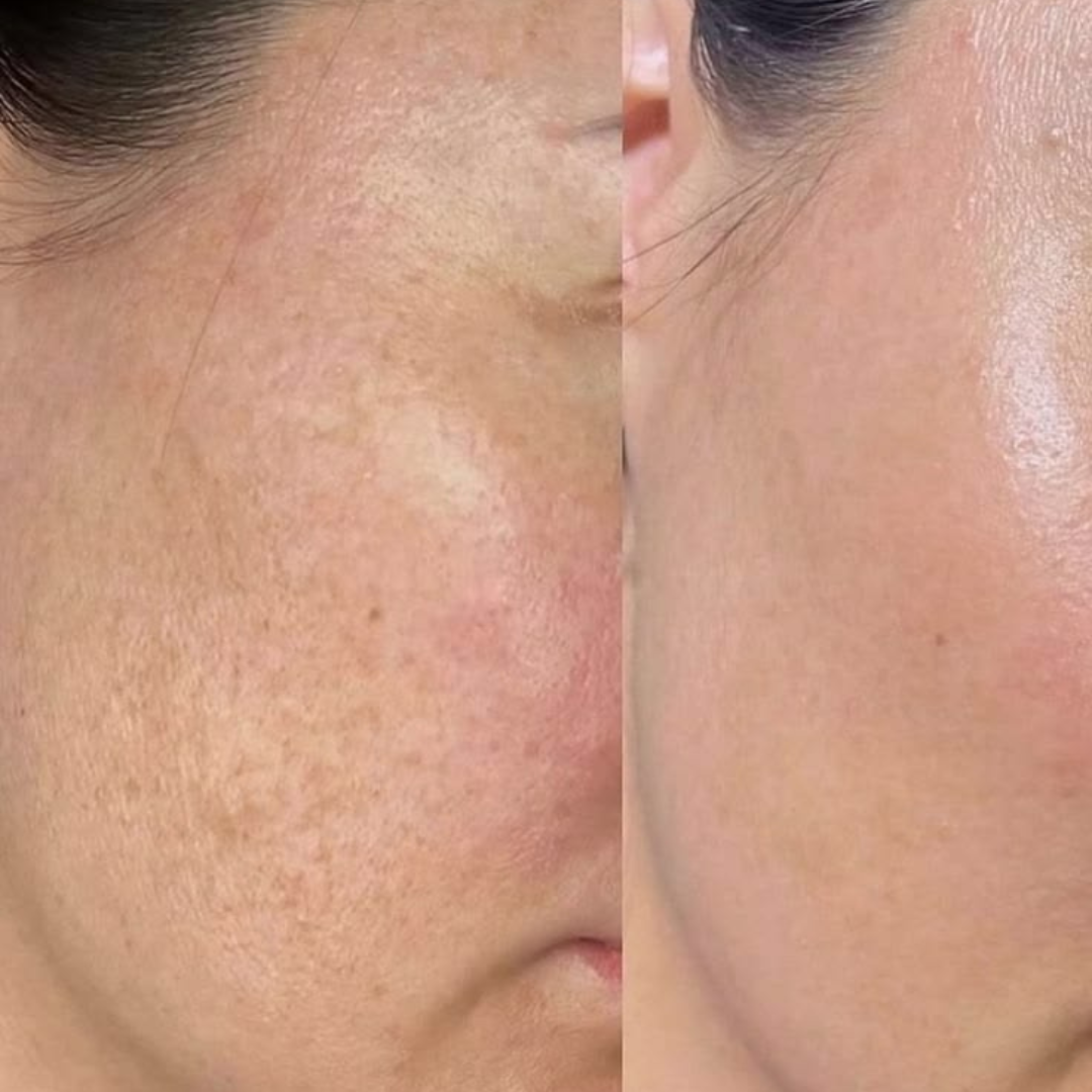 DermaFuture Precision Vitamin A Serum – Revitalizing Therapy for Acne Control, Wrinkle Reduction & Collagen Boost, High Potency Formula for Clear Skin