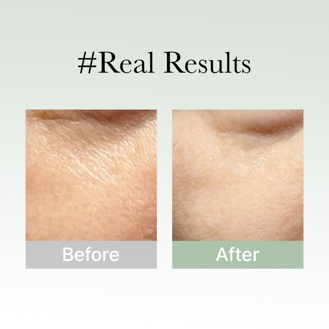 Arencia Holy Hyssop Serum - Remove Acne & dark sposts in 7 days