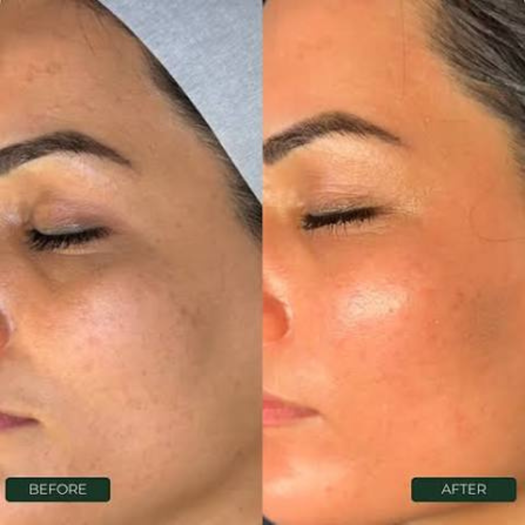 Mesoestetic Cream & Sunblock Deal - Reduce Pigmentation & Dark Spot - 50% Off - Complete care for hyperpigmentation