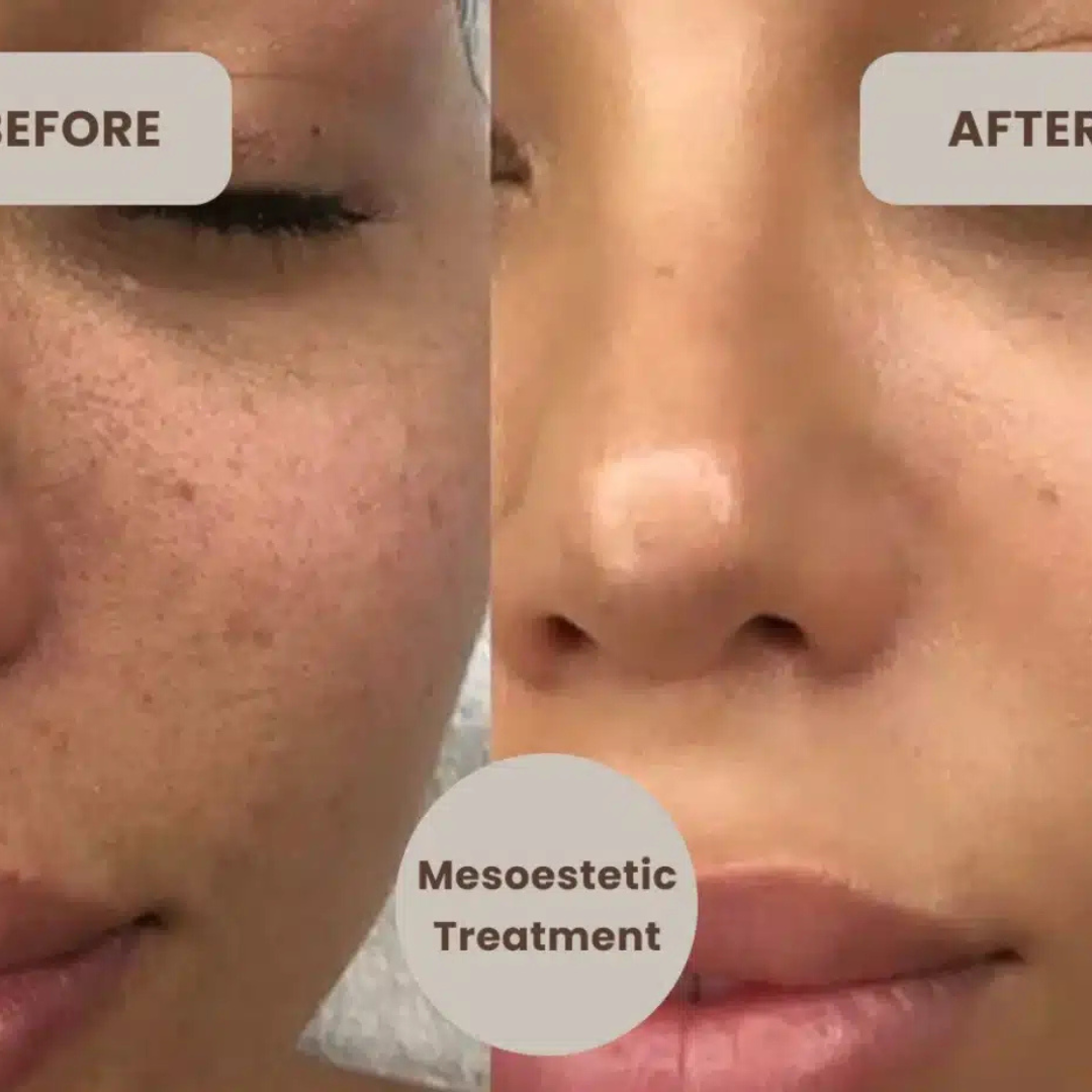 Mesoestetic Cream & Sunblock Deal - Reduce Pigmentation & Dark Spot - 50% Off - Complete care for hyperpigmentation