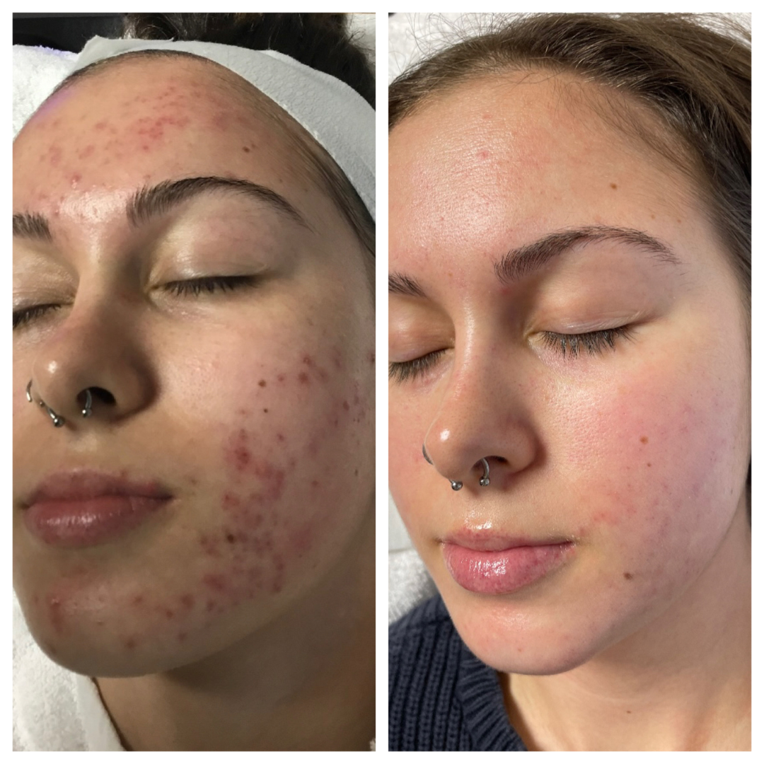 Clear Breakouts in 1 Hour | The Ordinary Powder-to-Cream + Ordinary Niacinamide Serum | Fastest Solution to reduce Acne, Spots & Redness