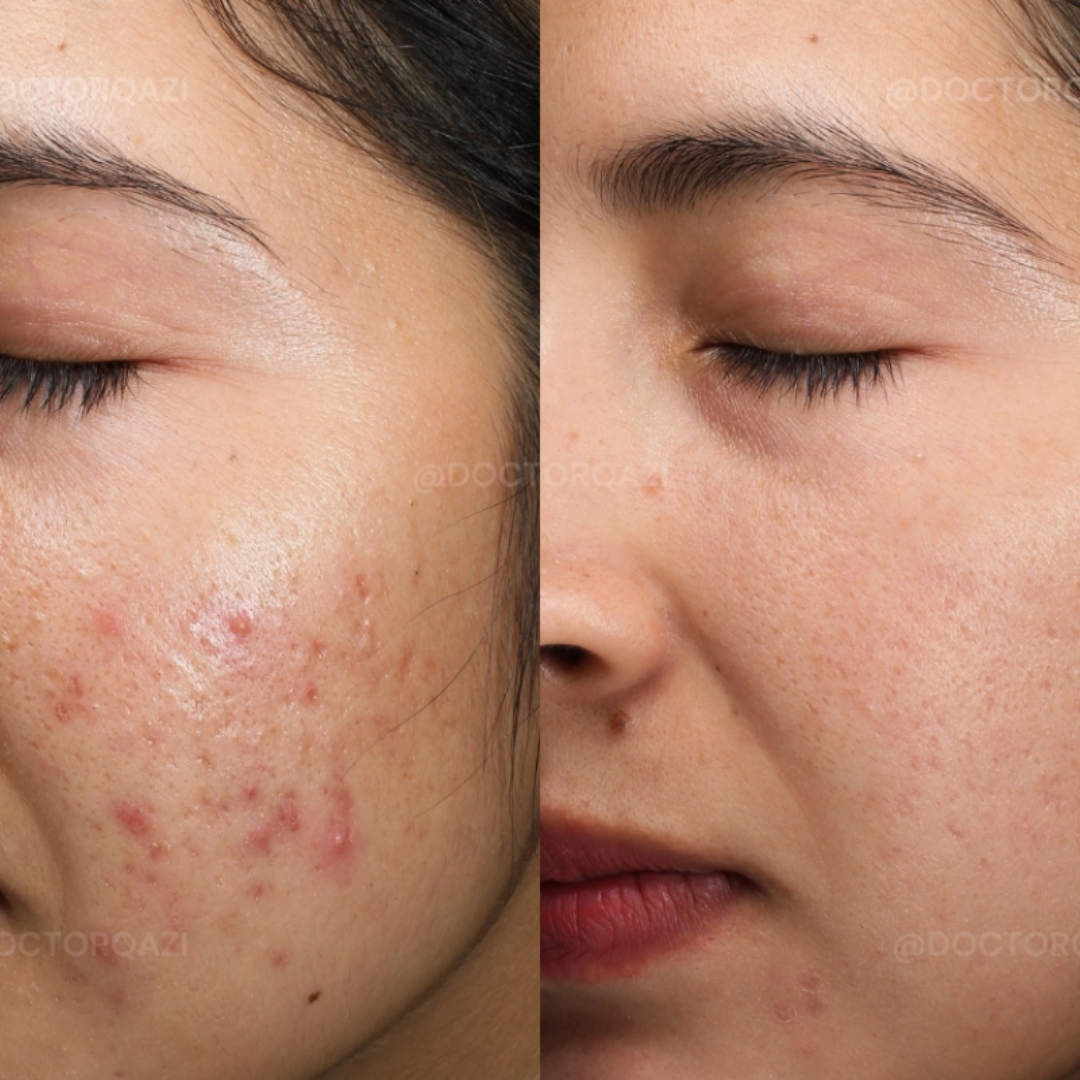 Clear Breakouts in 1 Hour | The Ordinary Powder-to-Cream + Ordinary Niacinamide Serum | Fastest Solution to reduce Acne, Spots & Redness