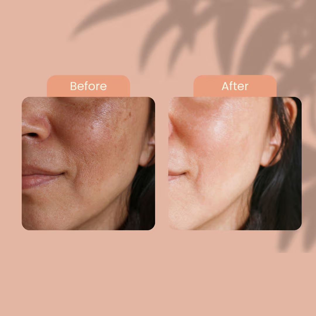 Mesoestetic Cream & Sunblock Deal - Reduce Pigmentation & Dark Spot - 50% Off - Complete care for hyperpigmentation