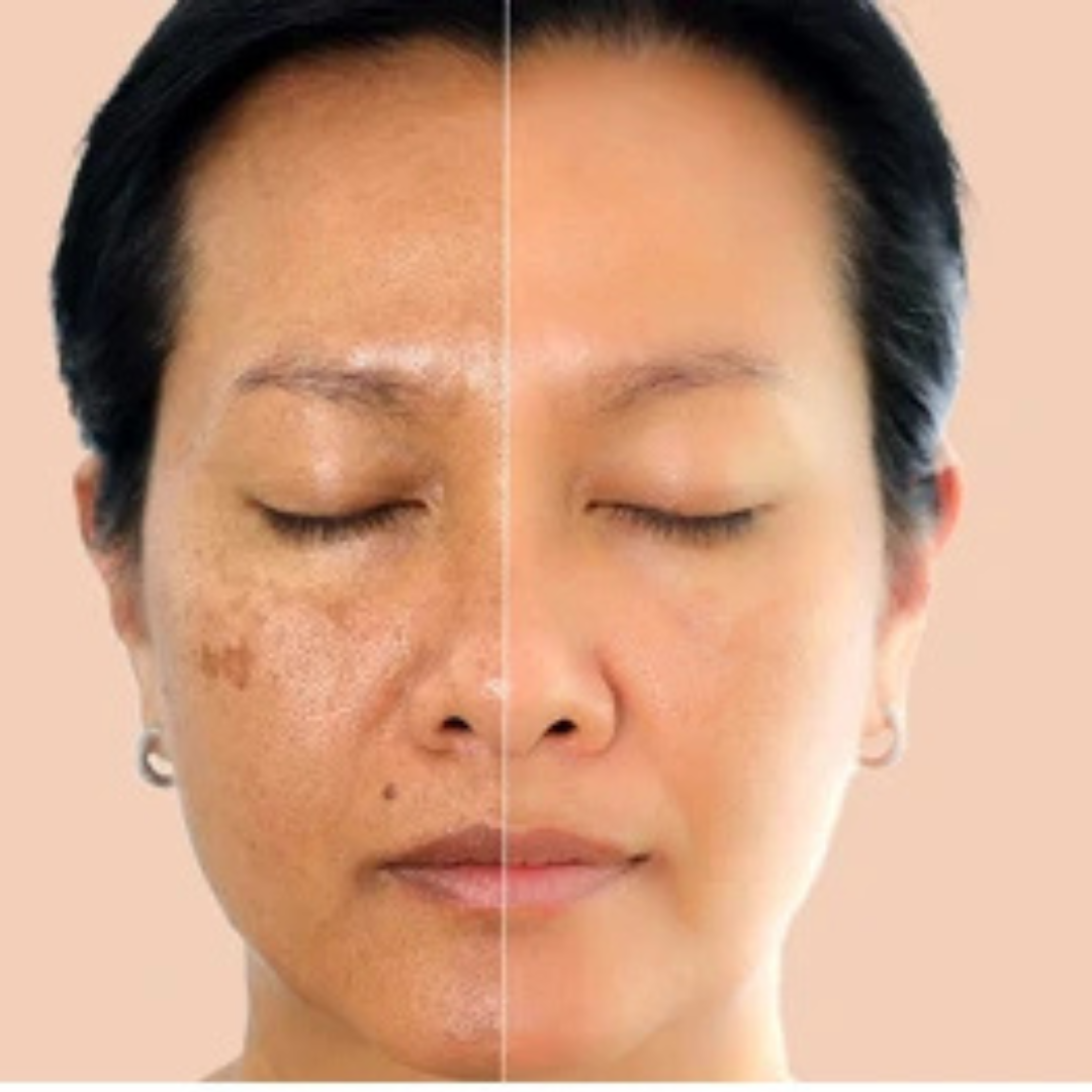 SL basics Natural Skin Tea | Balance Harmones &. Reduce Ance, pigmentation & bright complexion | Best for all Skin problems