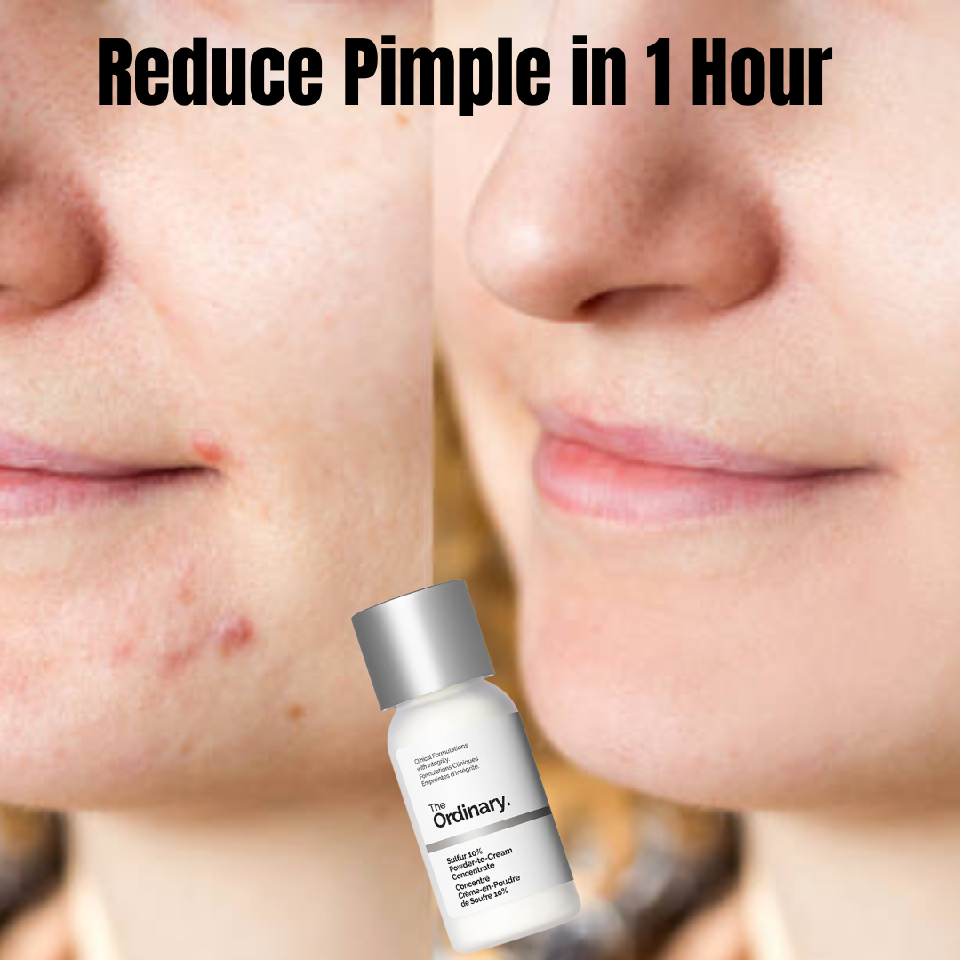 Clear Breakouts in 1 Hour | The Ordinary Powder-to-Cream + Ordinary Niacinamide Serum | Fastest Solution to reduce Acne, Spots & Redness