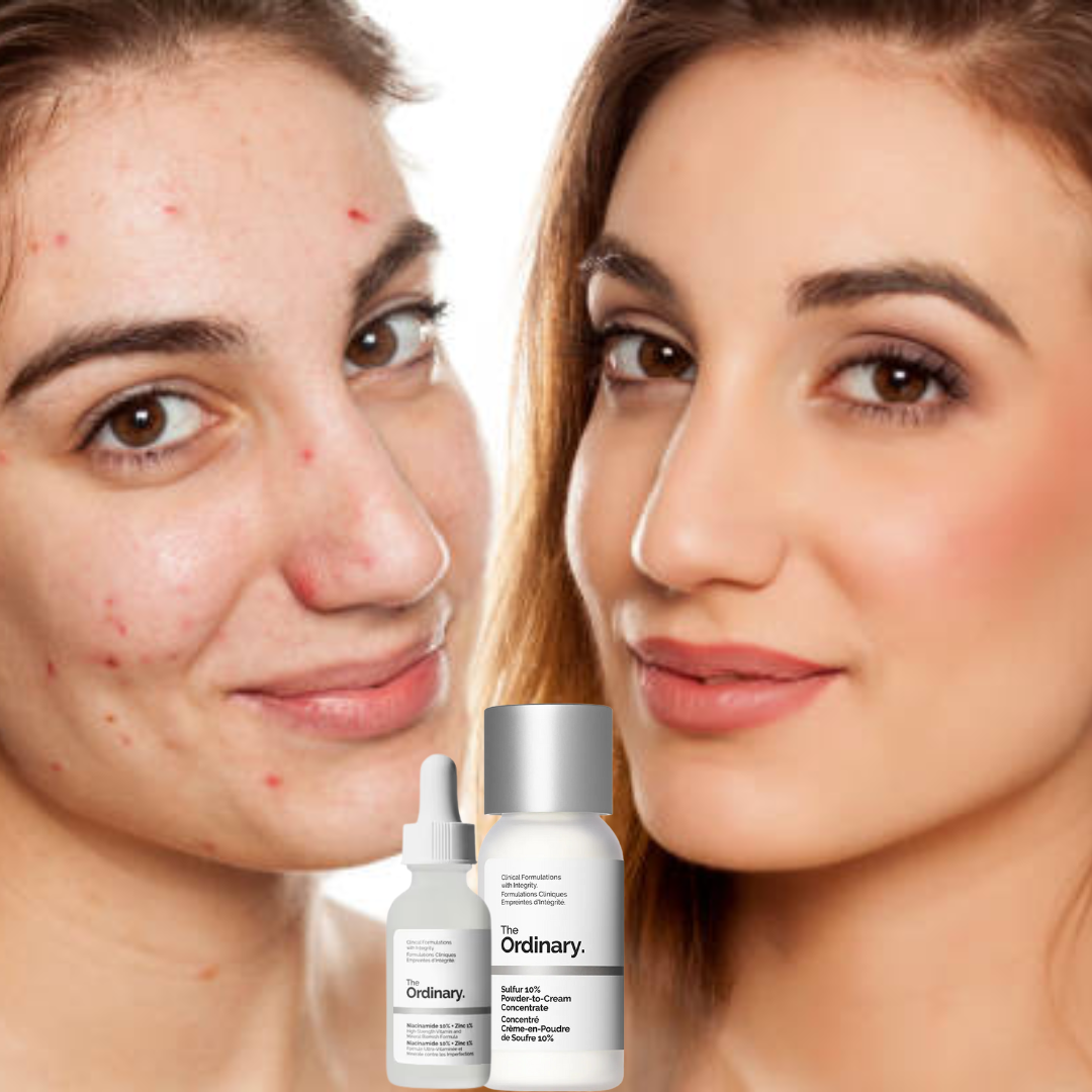Clear Breakouts in 1 Hour | The Ordinary Powder-to-Cream + Ordinary Niacinamide Serum | Fastest Solution to reduce Acne, Spots & Redness