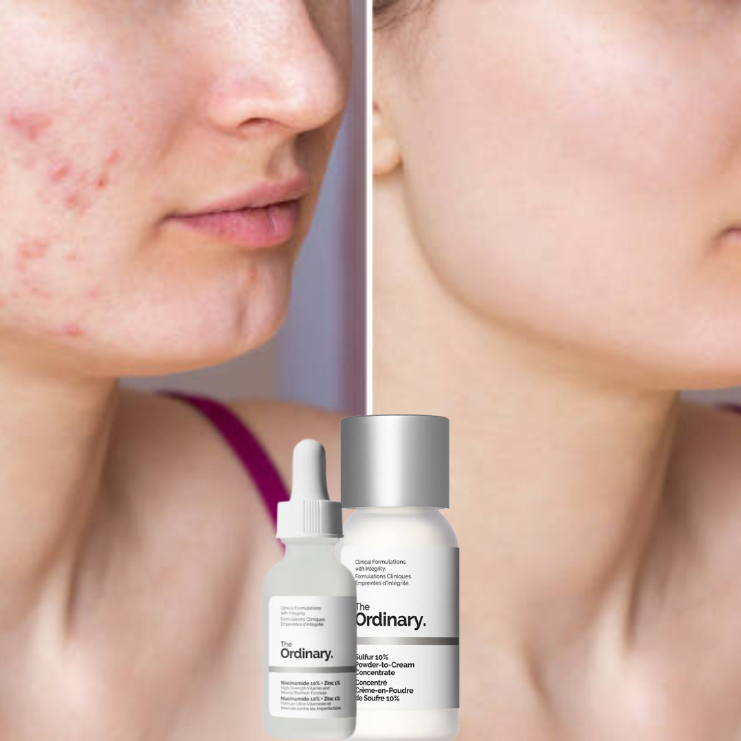 Clear Breakouts in 1 Hour | The Ordinary Powder-to-Cream + Ordinary Niacinamide Serum | Fastest Solution to reduce Acne, Spots & Redness