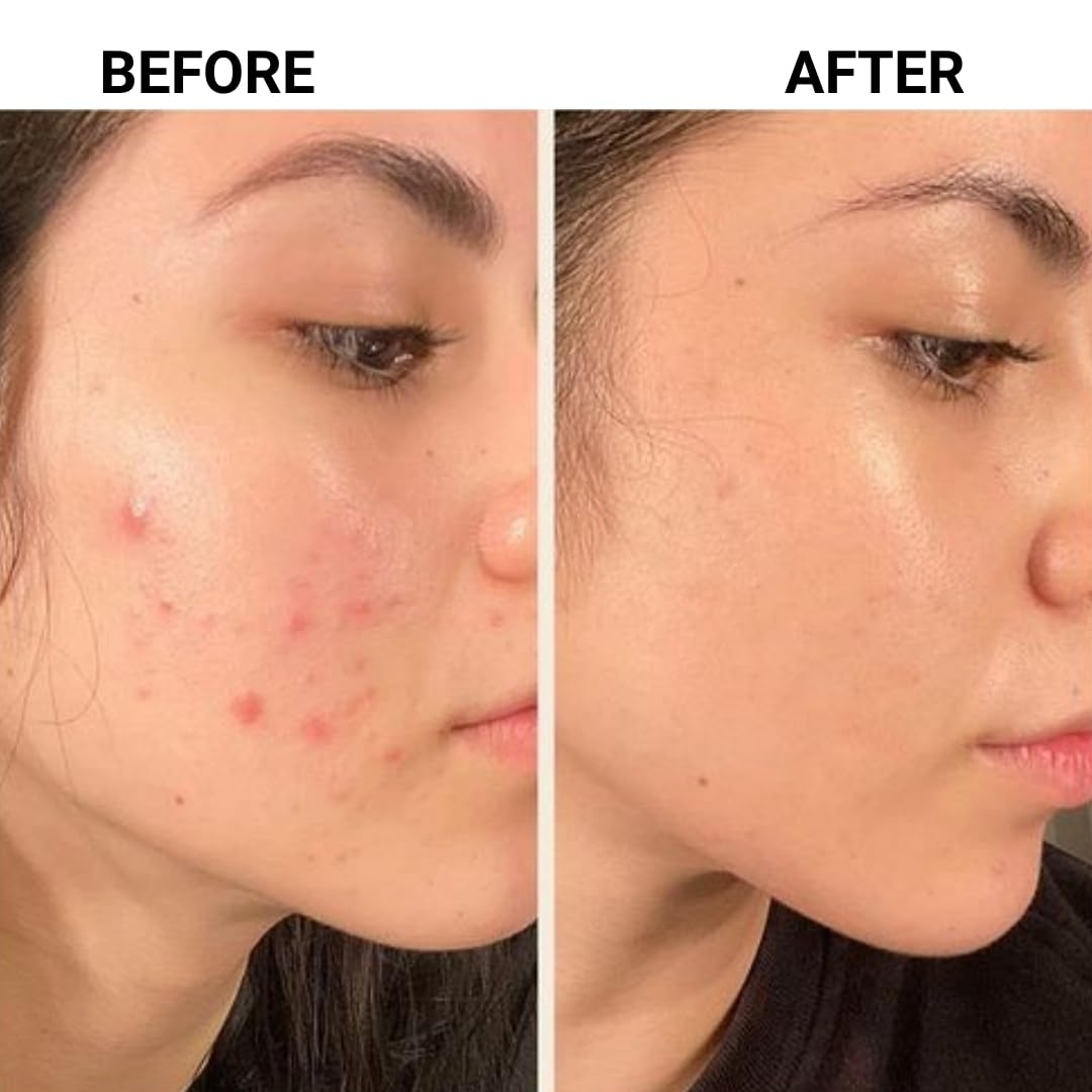 SL basics Natural Skin Tea | Balance Harmones &. Reduce Ance, pigmentation & bright complexion | Best for all Skin problems