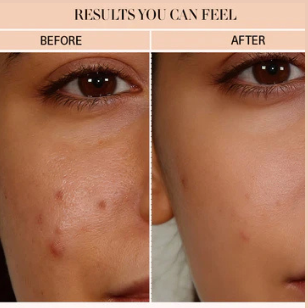 SL basics Natural Skin Tea | Balance Harmones &. Reduce Ance, pigmentation & bright complexion | Best for all Skin problems