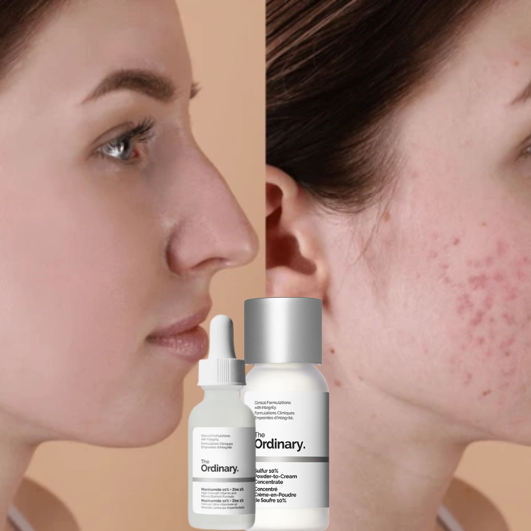Clear Breakouts in 1 Hour | The Ordinary Powder-to-Cream + Ordinary Niacinamide Serum | Fastest Solution to reduce Acne, Spots & Redness