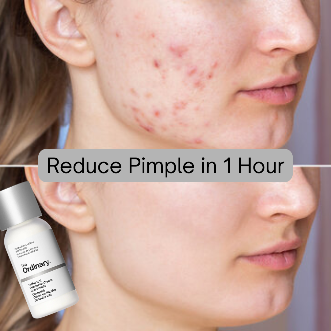 Clear Breakouts in 1 Hour | The Ordinary Powder-to-Cream + Ordinary Niacinamide Serum | Fastest Solution to reduce Acne, Spots & Redness