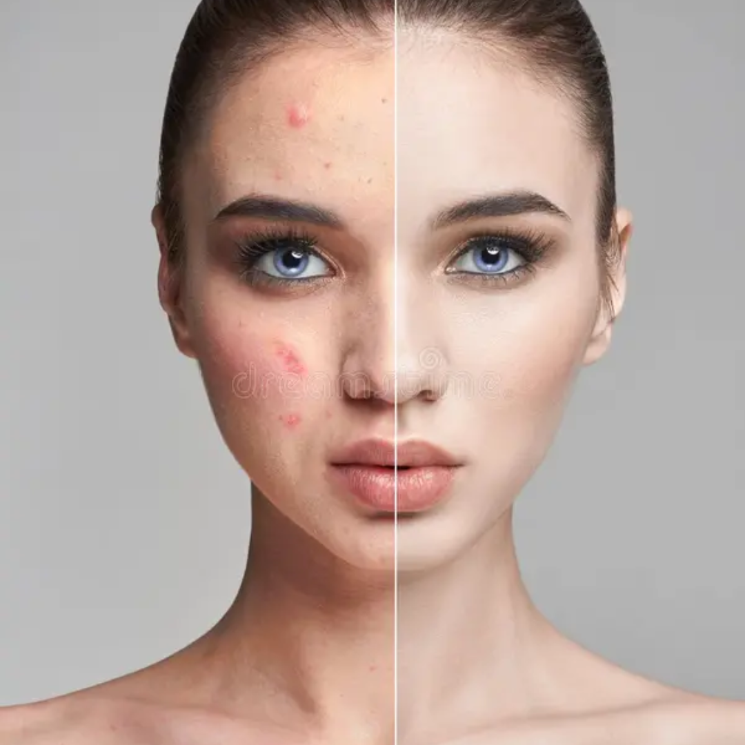 Clear Breakouts in 1 Hour | The Ordinary Powder-to-Cream + Ordinary Niacinamide Serum | Fastest Solution to reduce Acne, Spots & Redness