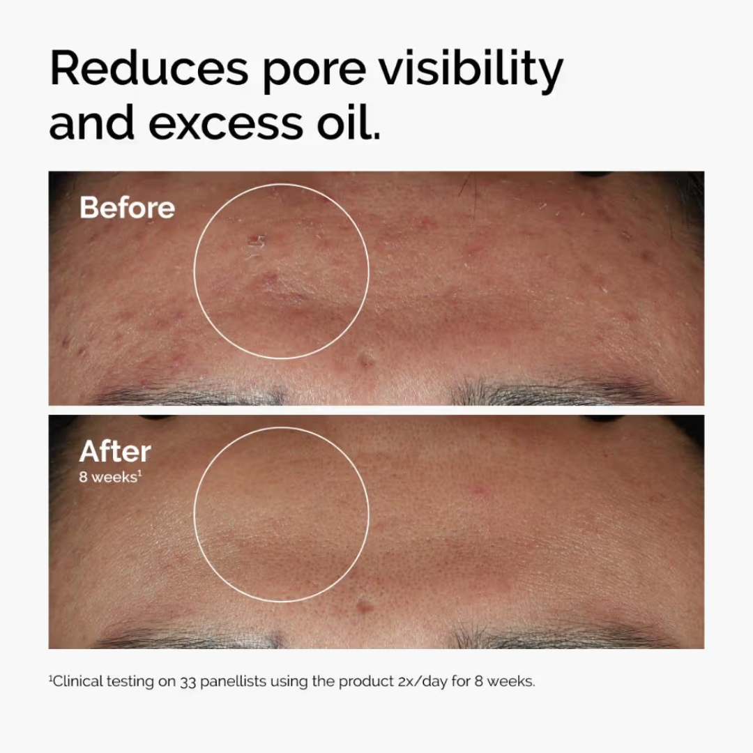 Clear Breakouts in 1 Hour | The Ordinary Powder-to-Cream + Ordinary Niacinamide Serum | Fastest Solution to reduce Acne, Spots & Redness